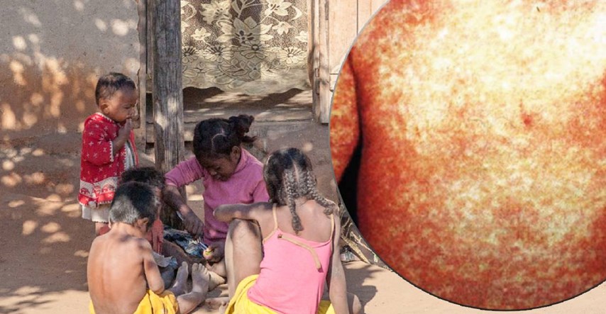 Epidemije ospica na Madagaskaru i Filipinima. Na stotine mrtvih